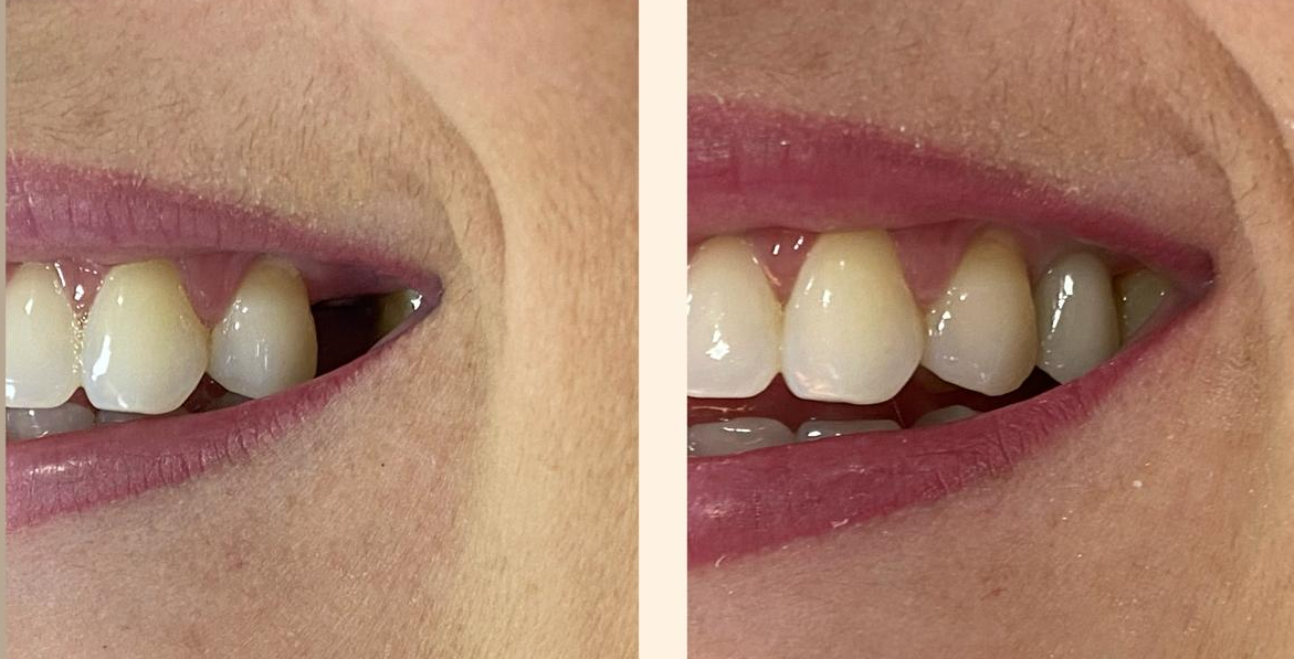 Implantes Dentários